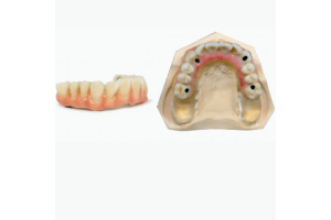Injektionstechnik für hochästhetische Versorgungen des vollständigen Zahnbogens